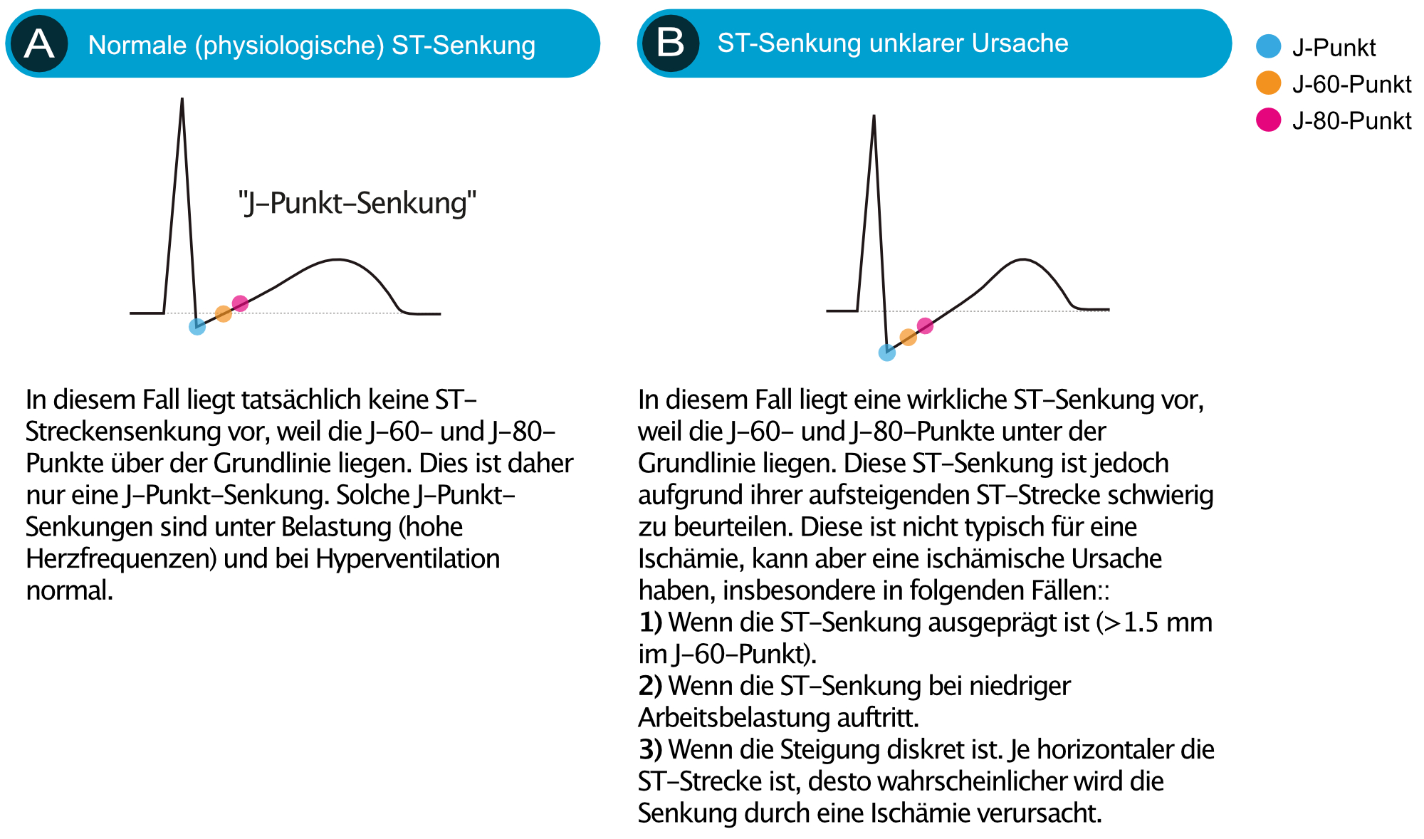 Abbildung 4. ST-Streckensenkungen, die nicht typisch für Myokardischämie sind.