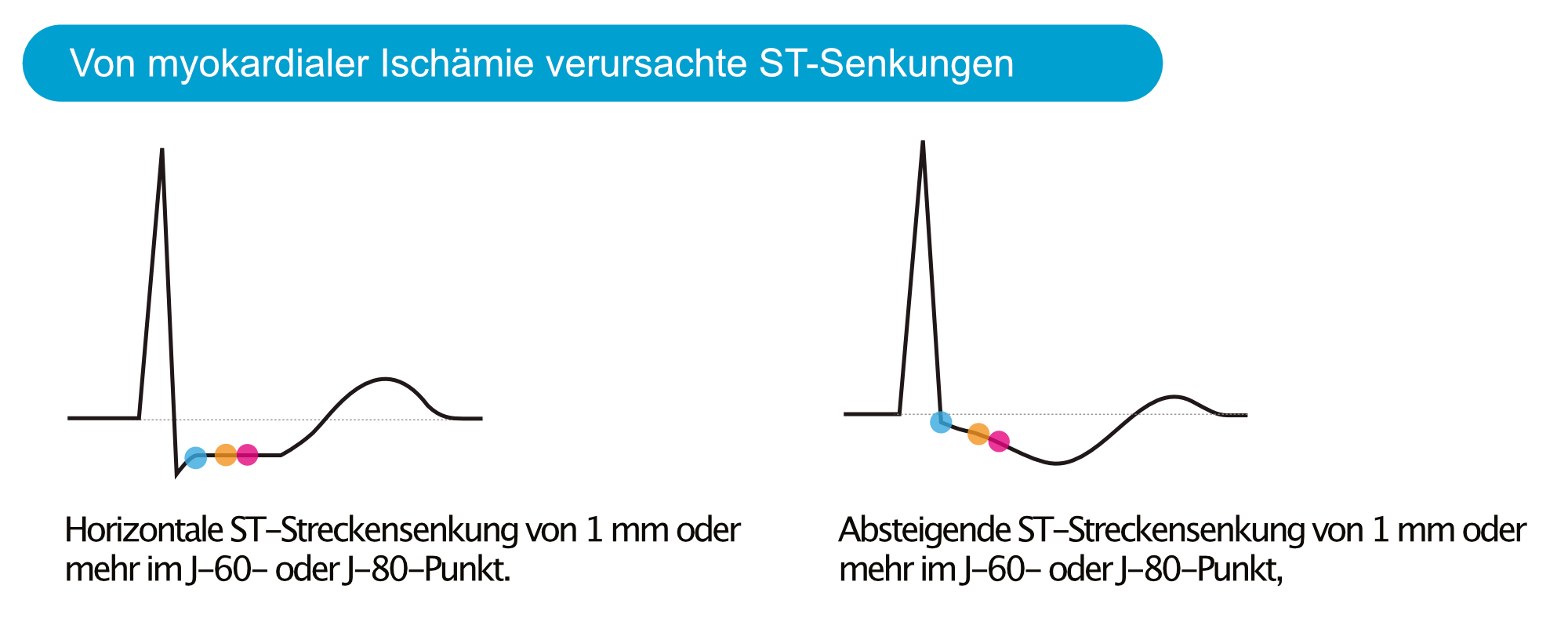 Abbildung 3. ST-Streckensenkungen, die typisch für eine anhaltende Myokardischämie sind.