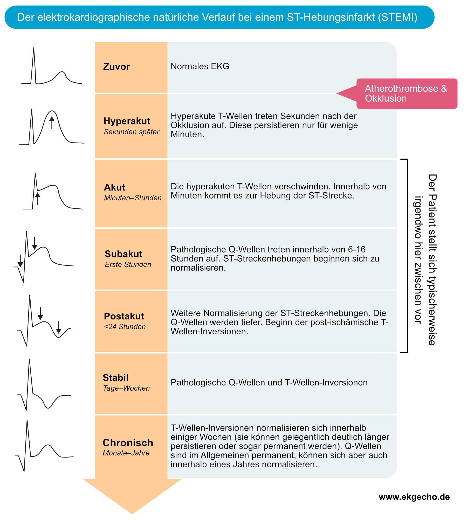 Abbildung 1. Der natürliche Verlauf eines STEMI (ST-Hebungsinfarkt) im EKG.