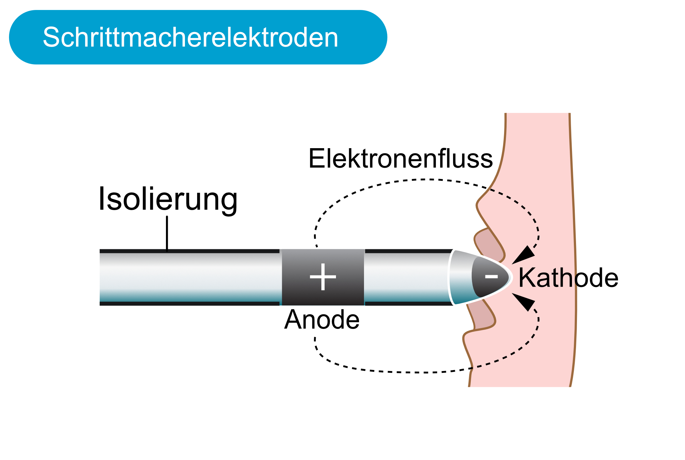 Abbildung 2. Schrittmacherelektroden.