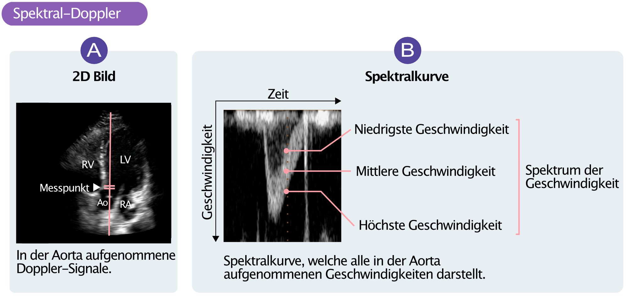 Abbildung 6. (A) Doppler-Aufnahme im linksventrikulären Ausflusstrakt (LVOT). Doppler-Signale werden in einem Punkt aufgezeichnet. (B) zeigt den resultierenden Spektral-Doppler, der sämtliche im Messpunkt aufgezeichneten Geschwindigkeiten zeigt.