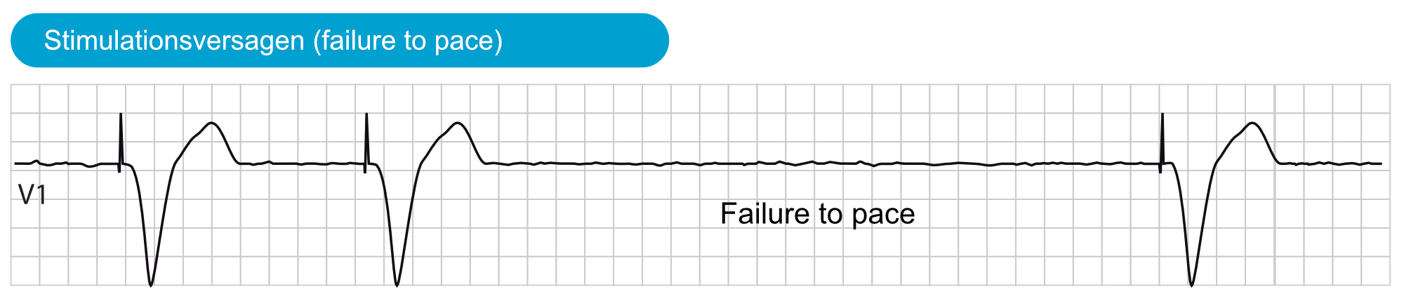 Abbildung 1. Stimulationsversagen (failure to pace).