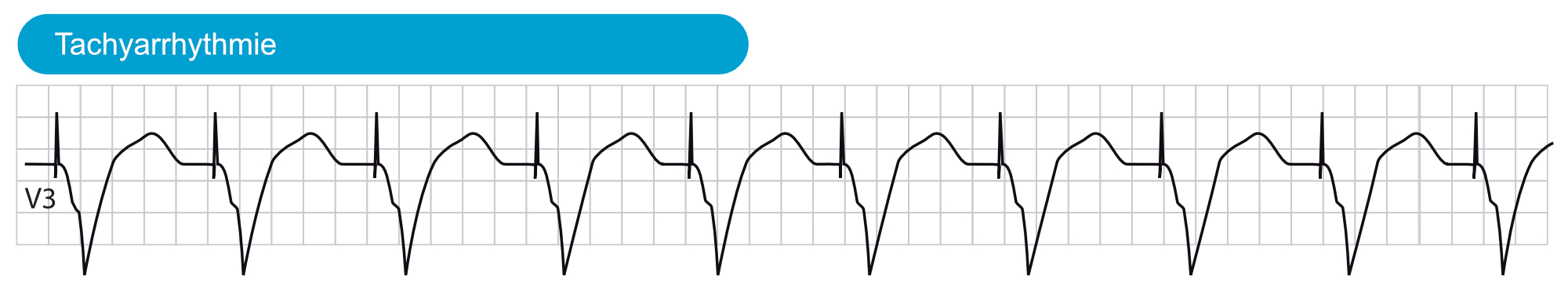 Abbildung 6. Tachyarrhythmie mit ventrikulärer Stimulation.