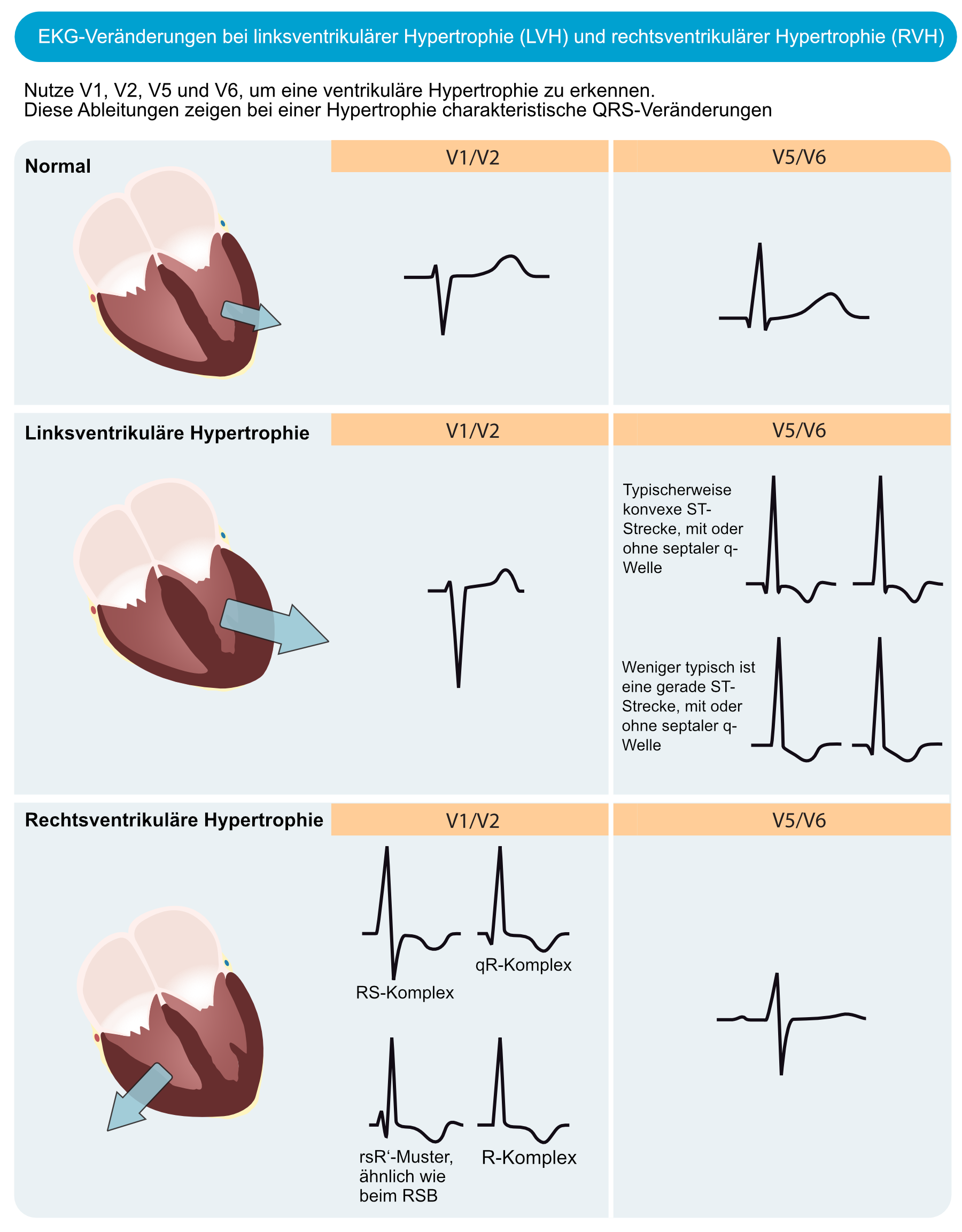 Abbildung 1. EKG-Veränderungen bei linksventrikulärer Hypertrophie (LVH) und rechtsventrikulärer Hypertrophie (RVH). Der elektrische Vektor des linken Ventrikels wird bei LVH verstärkt, was zu großen R-Wellen in den linksseitigen Leitungen (V5, V6, aVL und I) und tiefen S-Wellen in den rechtsseitigen Ableitungen (V1, V2) führt. Die rechtsventrikuläre Hypertrophie verursacht große R-Wellen in den rechtsseitigen Ableitungen und tiefe S-Wellen in den linksseitigen Ableitungen.