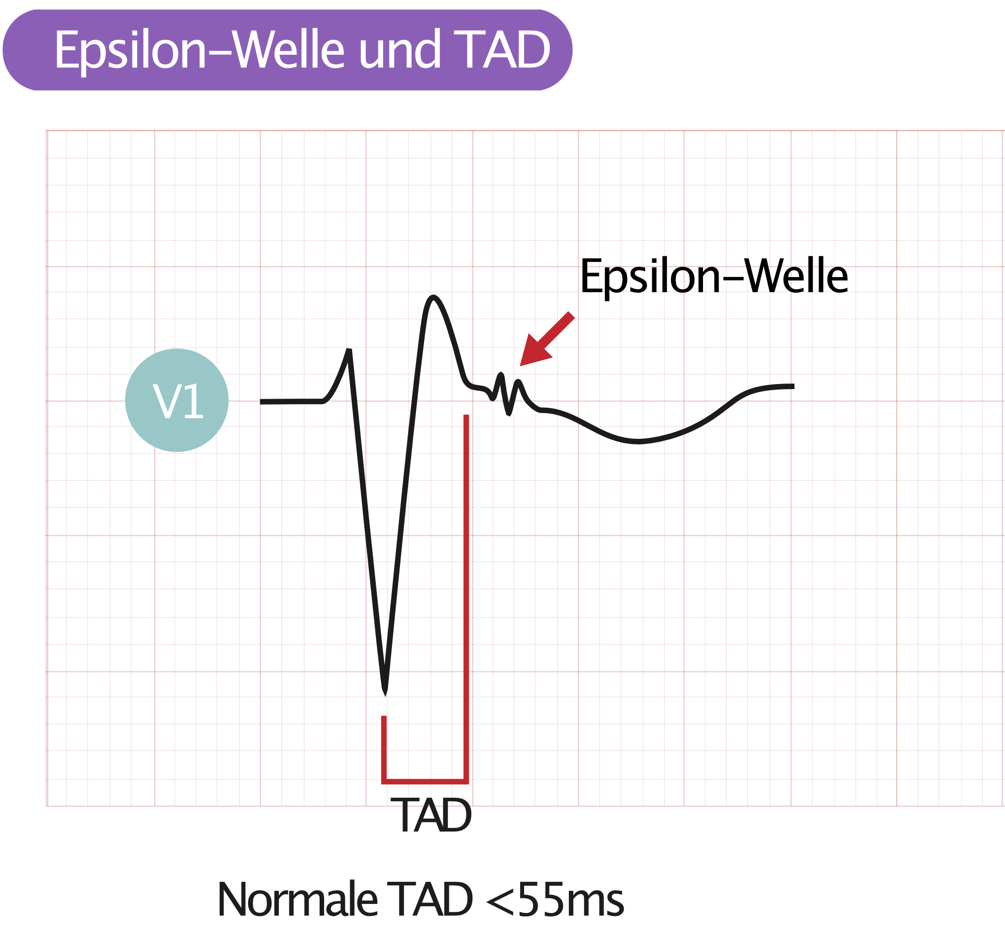 Abbildung 1. Epsilon-Welle und TAD auf dem Elektrokardiogramm (EKG).
