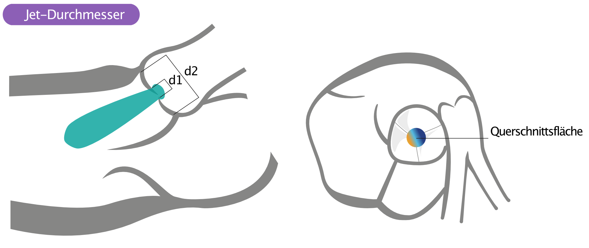 Abbildung 1. Durchmesser des Insuffizienzjets (Aortenklappeninsuffizienz).