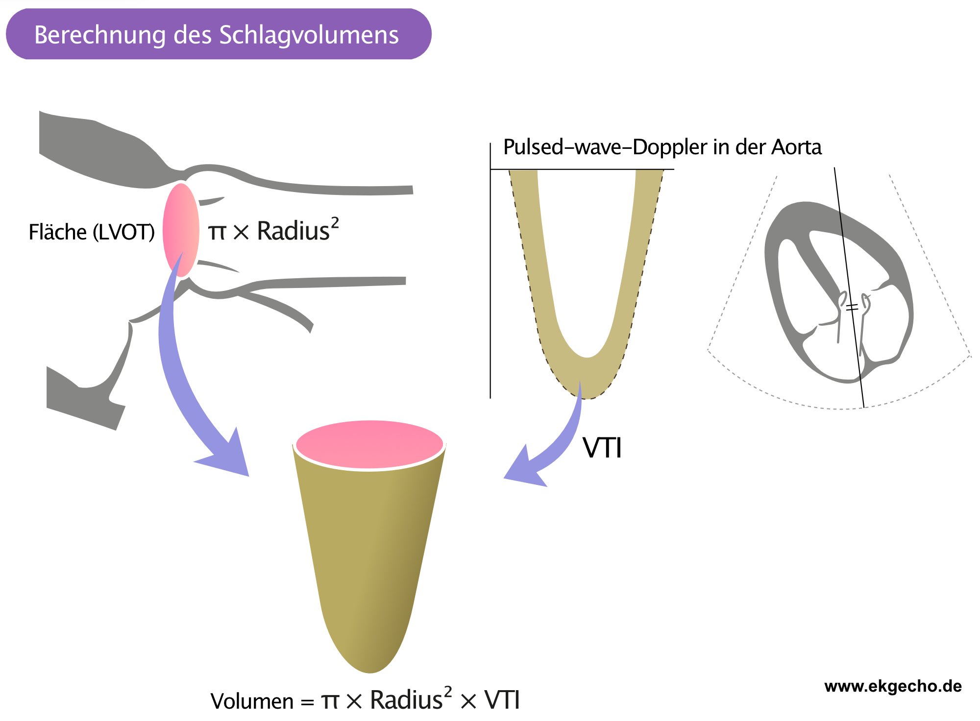 Abbildung 1. Berechnung des Schlagvolumen im LVOT unter Verwendung des pulsed-wave-Dopplers und der Messung des Durchmessers.