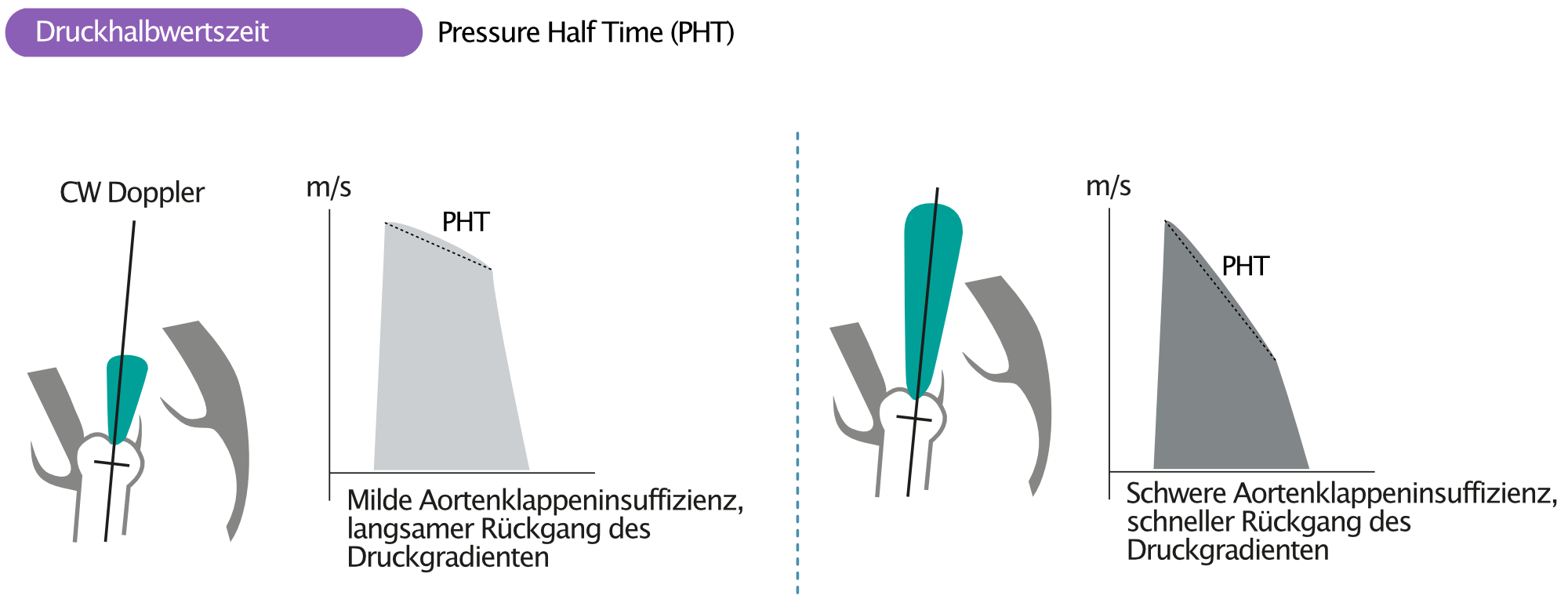 Abbildung 3. Beurteilung des Schweregrads der Aortenklappeninsuffizienz anhand der Druckhalbwertszeit.