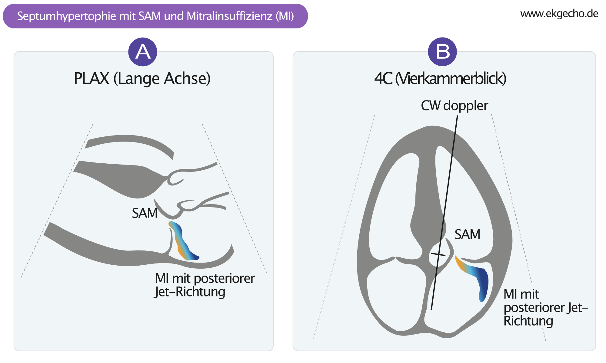 Abbildung 2. Die systolic anterior motion (SAM) des vorderen Mitralklappensegels verursacht eine Obstruktion des LVOT. SAM geht typischerweise mit einer Mitralklappeninsuffizienz (MI) mit nach hintem gerichteten Jet einher. CW = kontinuierliche Doppler.