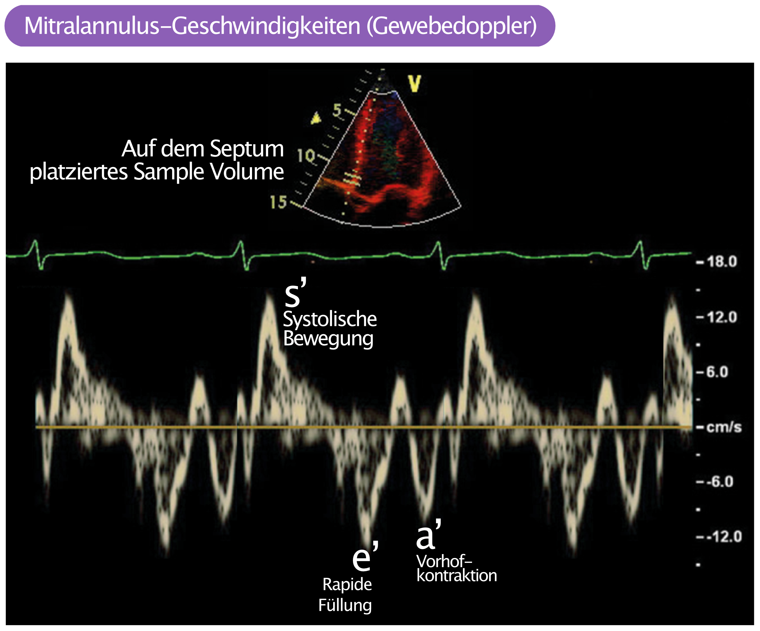 Abbildung 3. Die Mitralannulus-Geschwindigkeiten während der Systole und Diastole, die mit dem Gewebedoppler mit einer Sample-Volume-Position 1 cm unterhalb der Mitralringebene aufgezeichnet wurde. Das Sample Volume kann entweder medial oder lateral platziert werden.