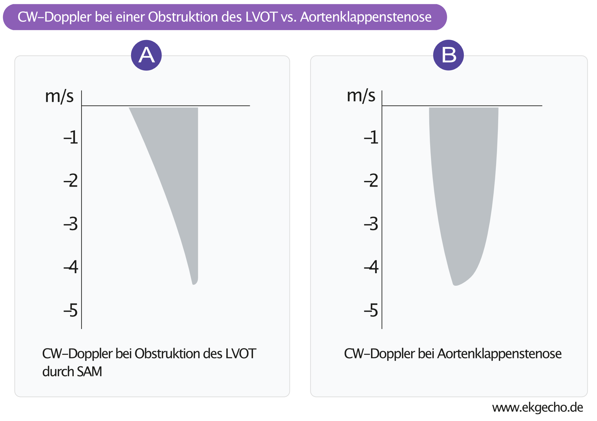 Abbildung 3. Kontinuierlicher Doppler (cw) im LVOT bei (A) Obstruktion aufgrund von SAM und Septumhypertrophie und (B) Aortenklappenstenose.