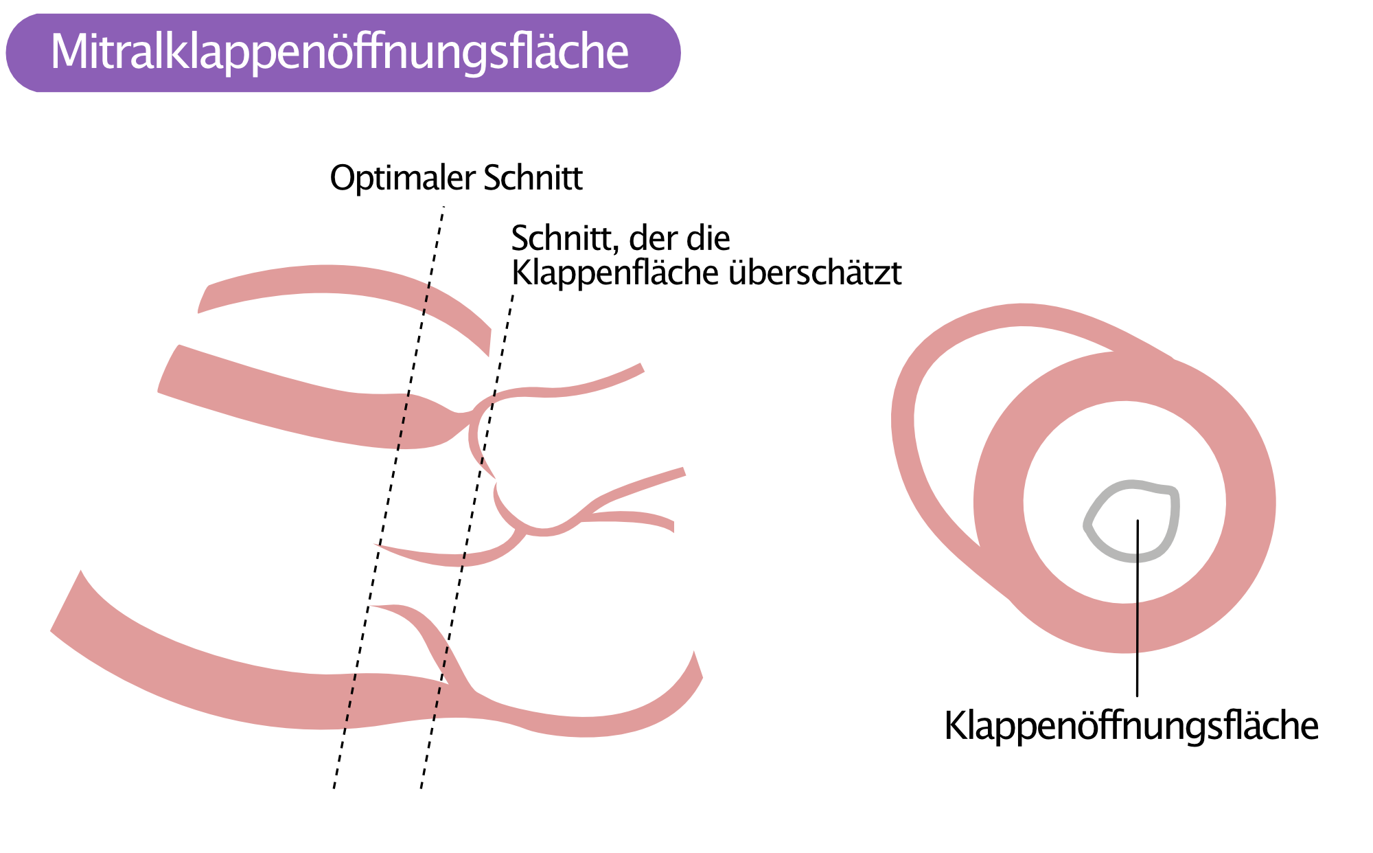 Abbildung 2. Mitralklappenöffnungsfläche.