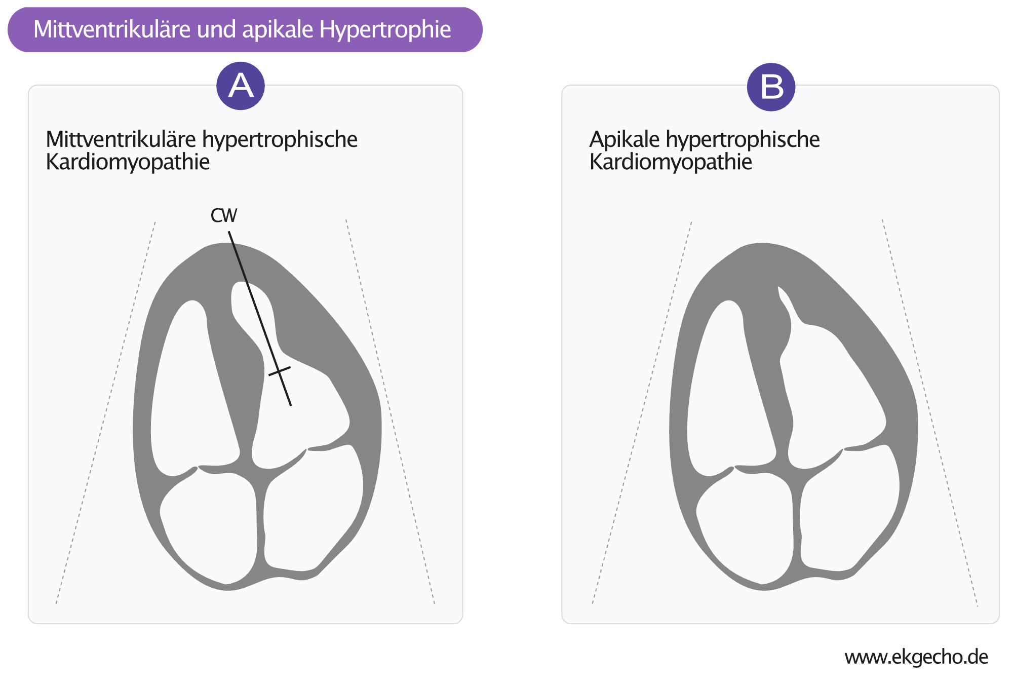 Abbildung 4. Mittventrikuläre und apikale hypertrophe Kardiomyopathie.