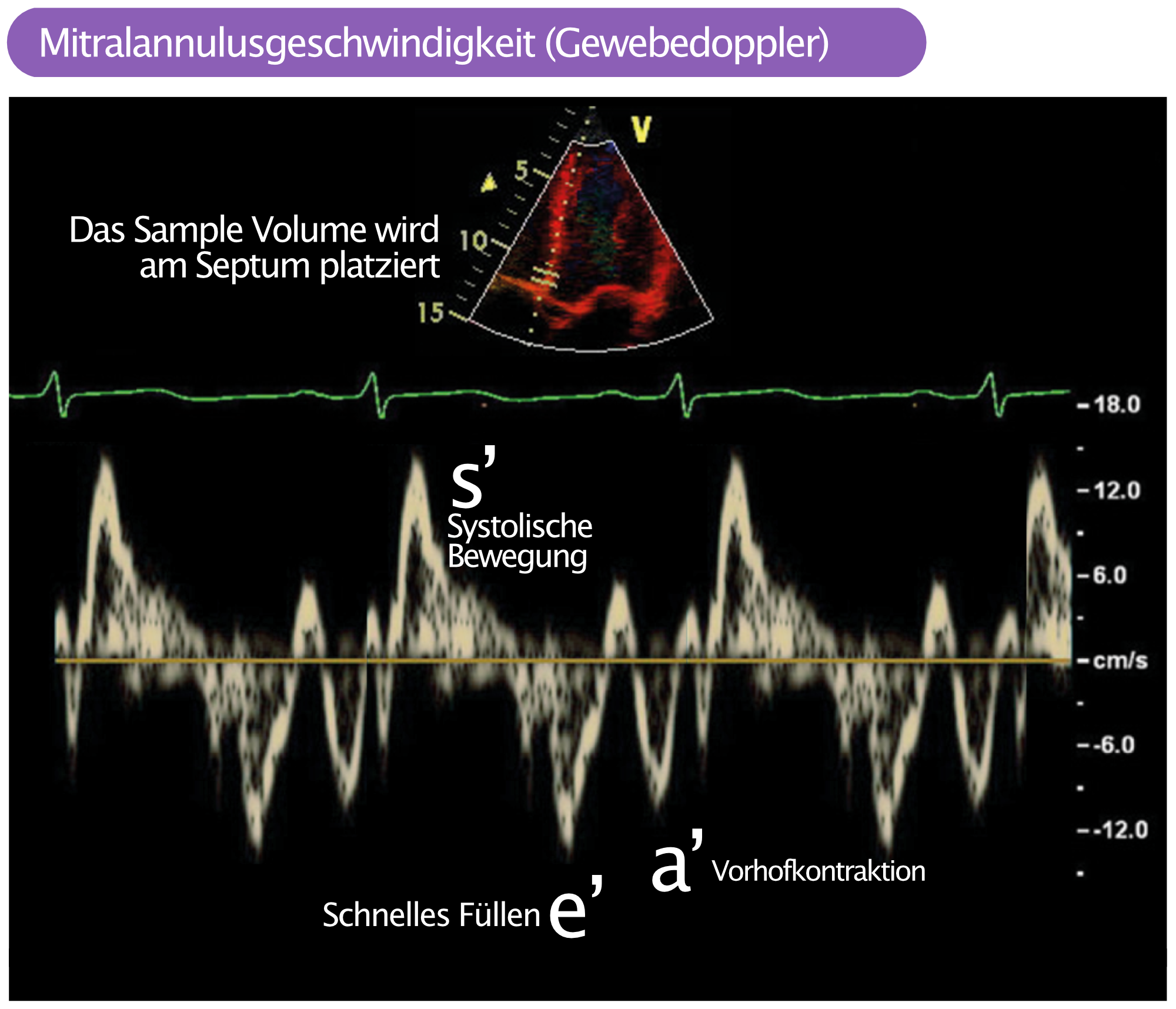 Abbildung 2. Gepulster Gewebedoppler, der die Bewegungen vom Mitralannulus analysiert.