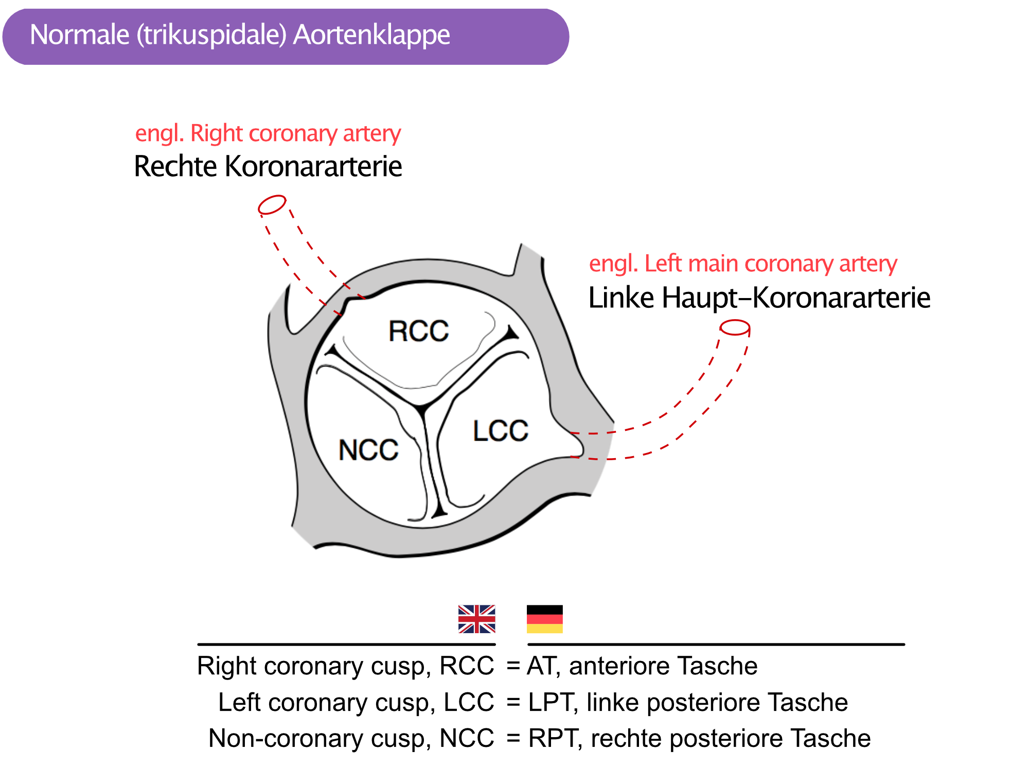 Abbildung 2. Normale (trikuspide) Aortenklappe mit drei Taschen (AT, RPT, LPT). Die rechte Koronararterie verlässt die anteriore Tasche (AT) und die linke Haupt-Koronararterie verlässt die linke posteriore Tasche (LPT). RPT = rechte posteriore Tasche.