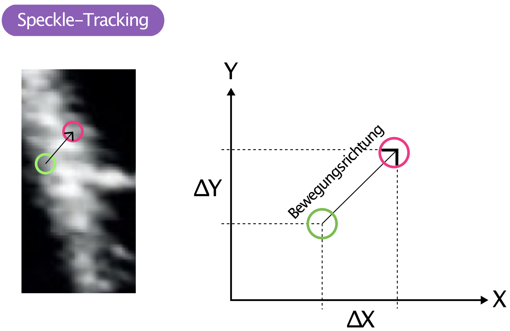 Abbildung 9. Speckle-Tracking.