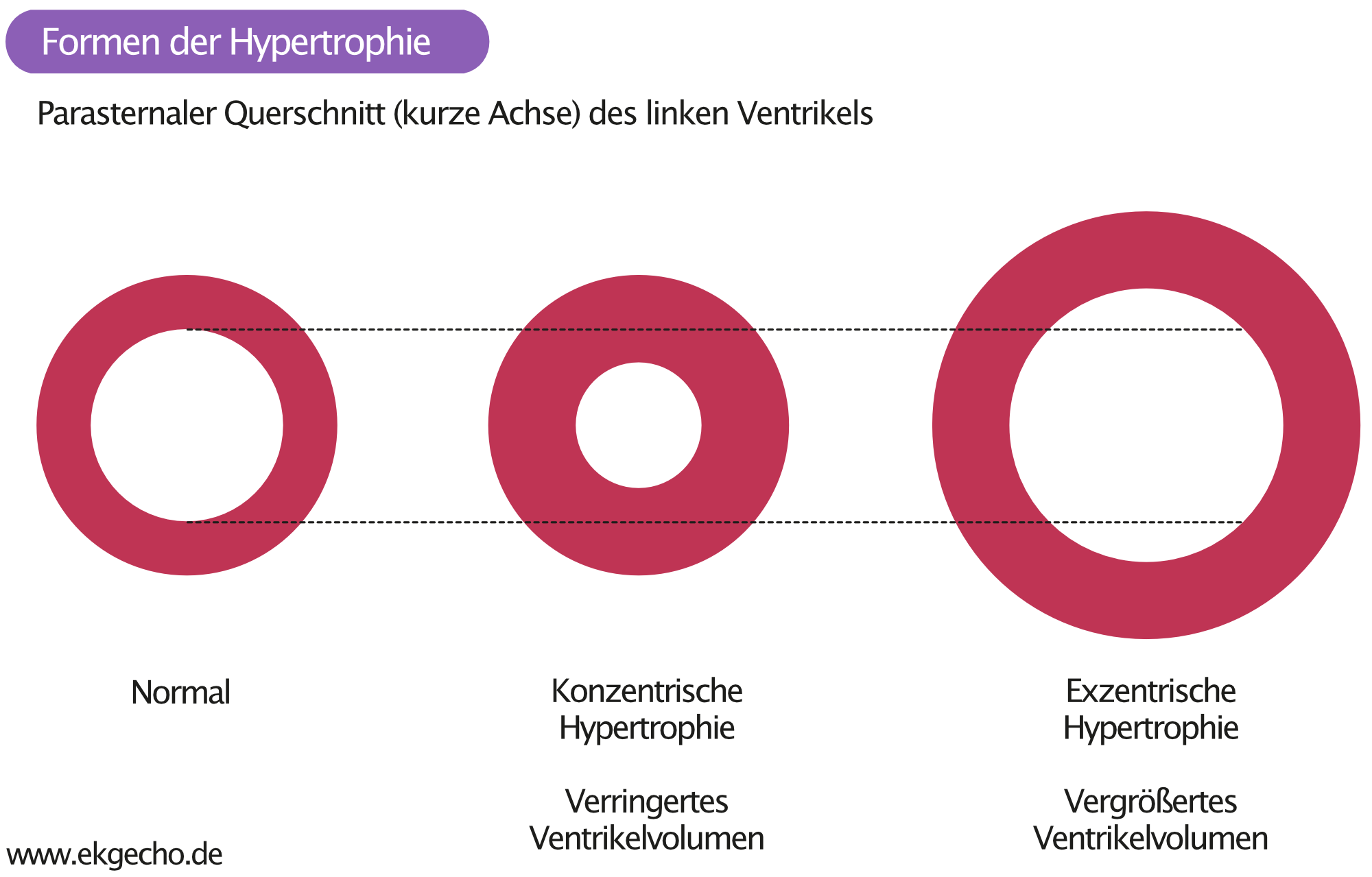 Abbildung 1. Formen der linksventrikuläre Hypertrophie. Das linksventrikuläre Volumen ist bei konzentrischer Hypertrophie reduziert. Die exzentrische Hypertrophie führt zu einem erhöhten Ventrikelvolumen.