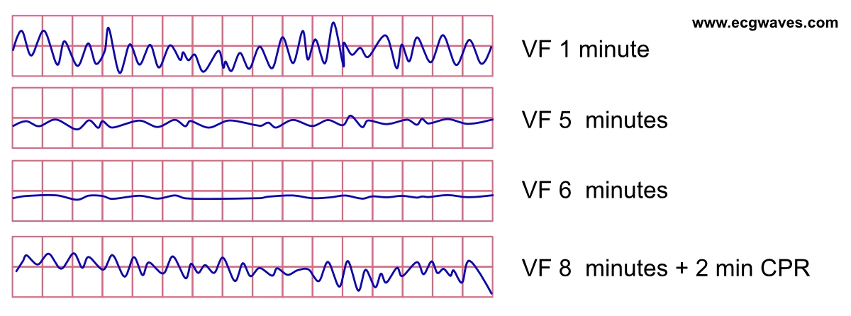 EKG-Streifen mit dem Übergang von grobem Kammerflimmern mit großen Flimmerwellen zu feinem Kammerflimmern mit kleiner Amplitude.