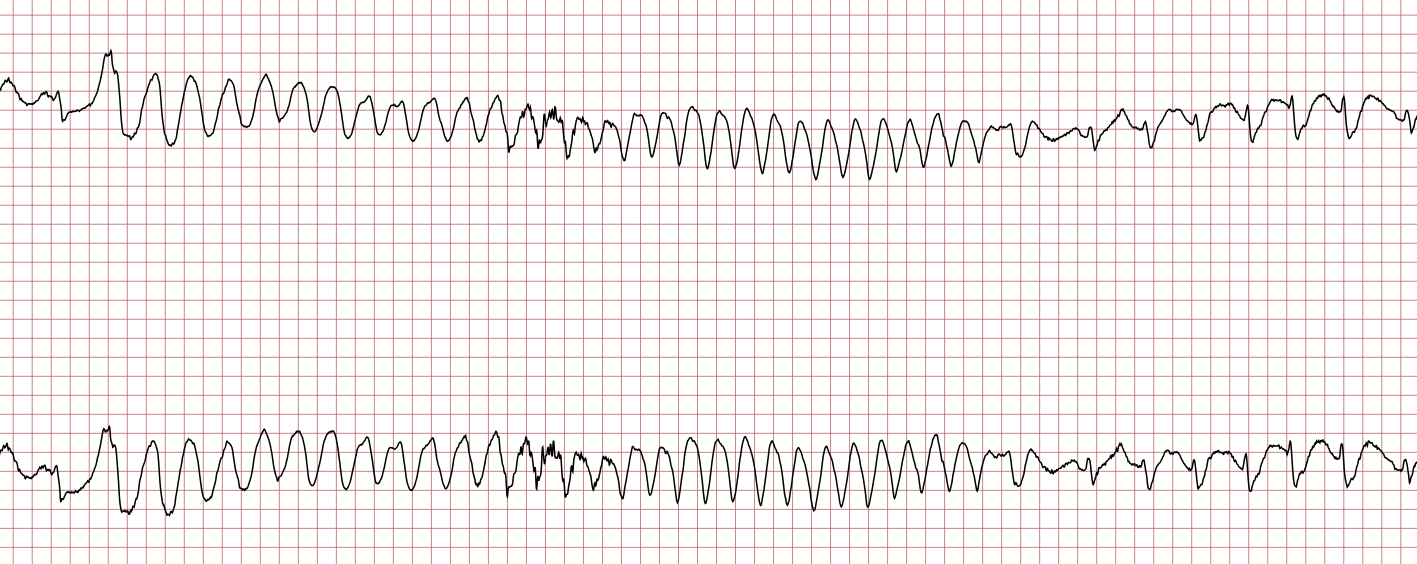 EKG 2 (Fall 4): die ventrikuläre Tachykardie endet ohne Intervention