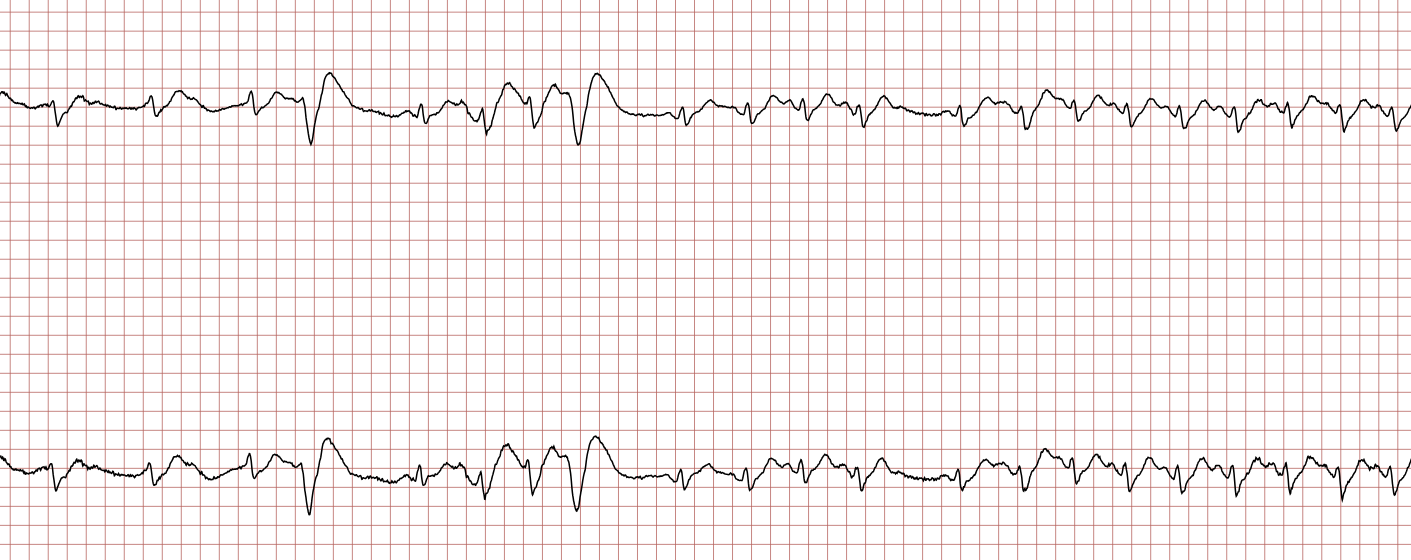 EKG 3 (Fall 4): ein einzelner ventrikulärer Schlag, gefolgt von einer Salve aus drei ventrikulären Schlägen
