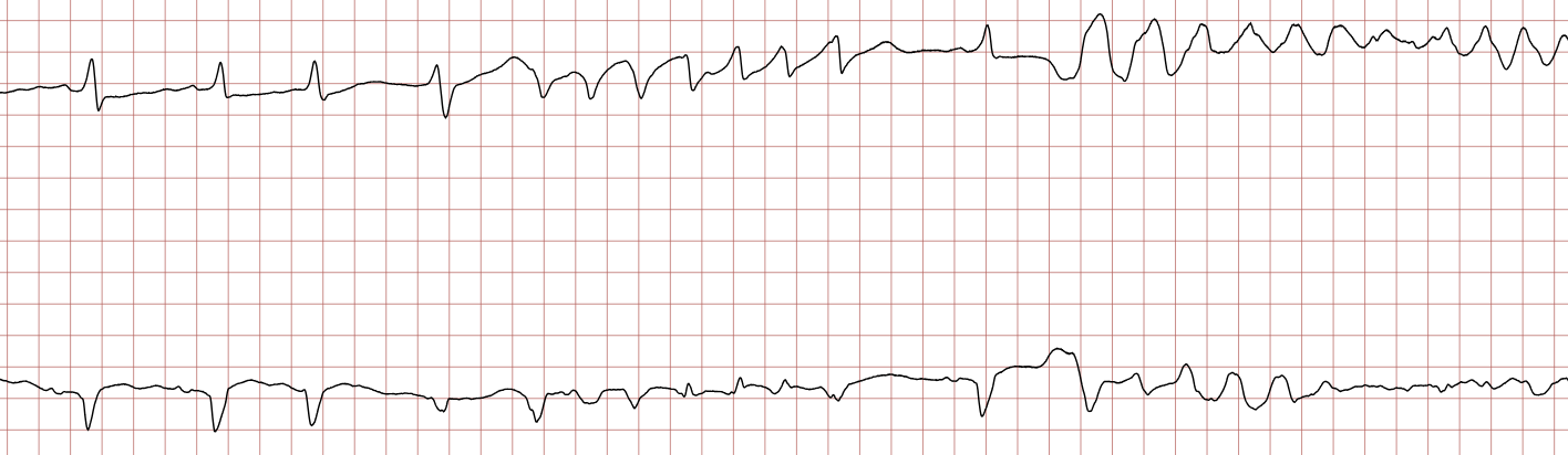 EKG 1 (Fall 1): zwei Kanäle mit vier Sinusschlägen, danach kurze, wiederkehrende Salven einer polymorphen ventrikulären Tachykardie