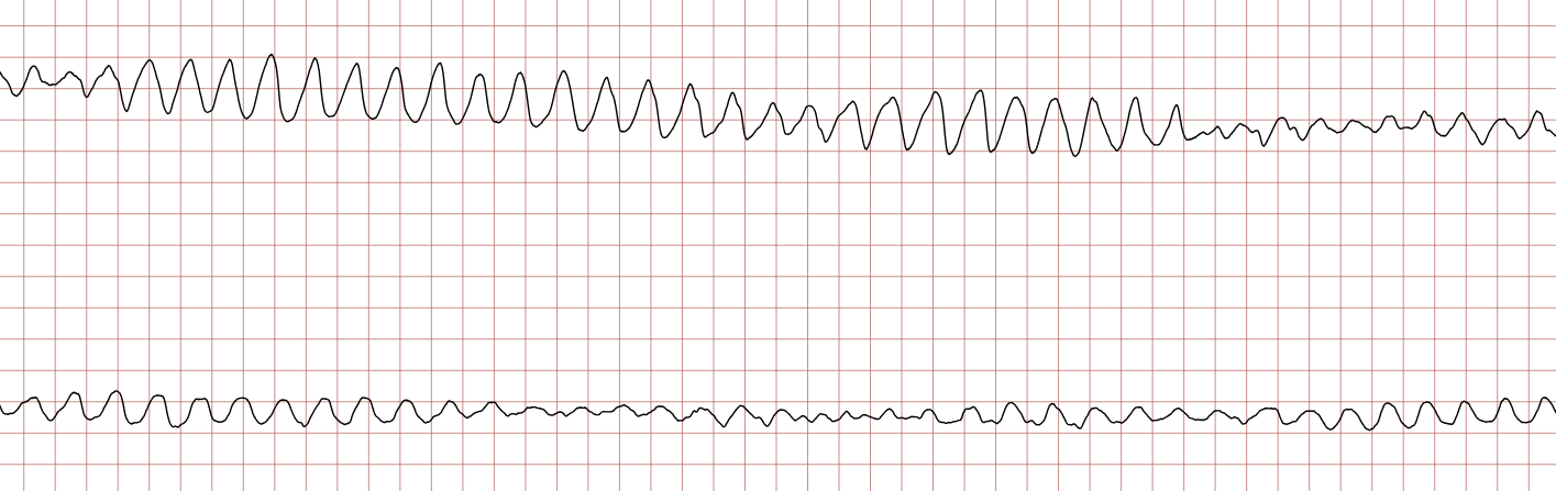EKG 2 (Fall 1): Kammerflattern mit regelmäßiger, sinusförmiger Kurve hoher Frequenz