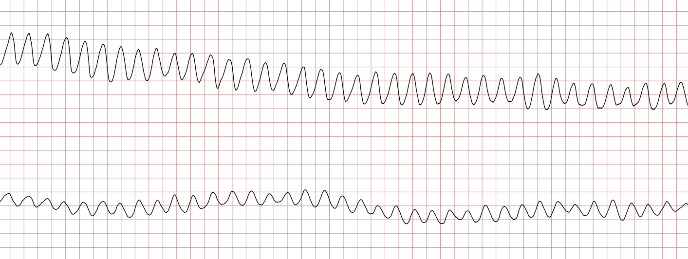 EKG 4 (Fall 1): anhaltendes Kammerflattern