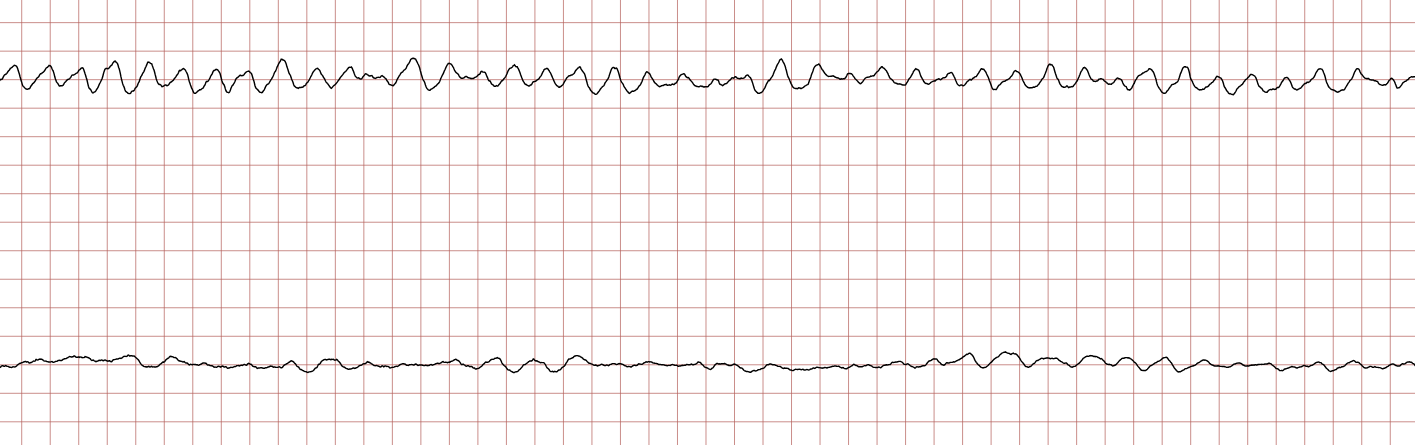 EKG 5 (Fall 1): Kammerflattern, das in unregelmäßiges Kammerflimmern übergeht