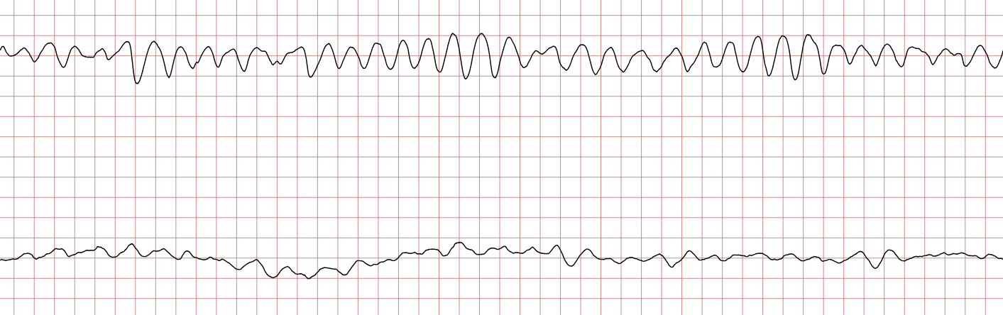 EKG 6 (Fall 1): Kammerflattern mit Übergang in Kammerflimmern