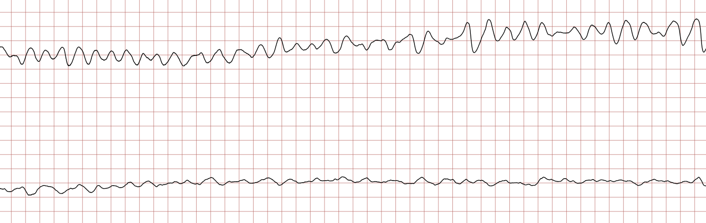 EKG 7 (Fall 1): Kammerflimmern mit völlig unregelmäßigen Flimmerwellen