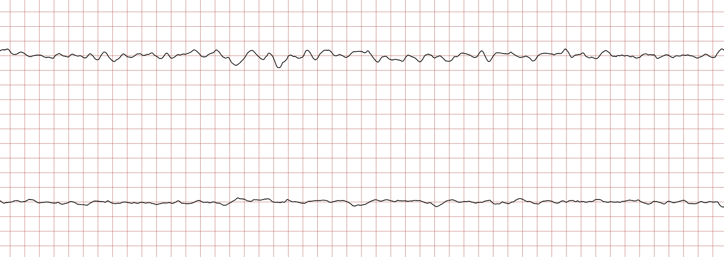 EKG 8 (Fall 1): fortbestehendes Kammerflimmern