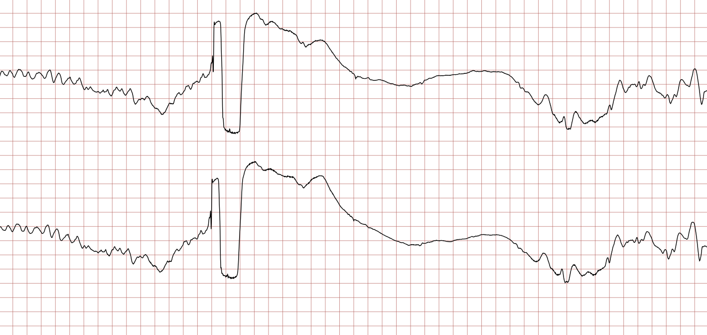 EKG 11 (Fall 2): erneutes Kammerflimmern mit Schockartefakt