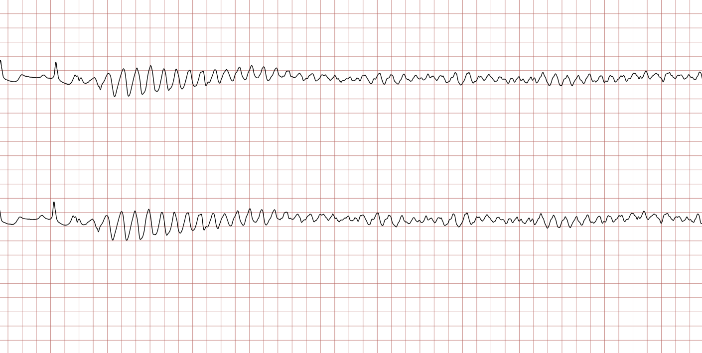 EKG 2 (Fall 2): ventrikuläre Tachykardie, die in unregelmäßiges Kammerflimmern übergeht