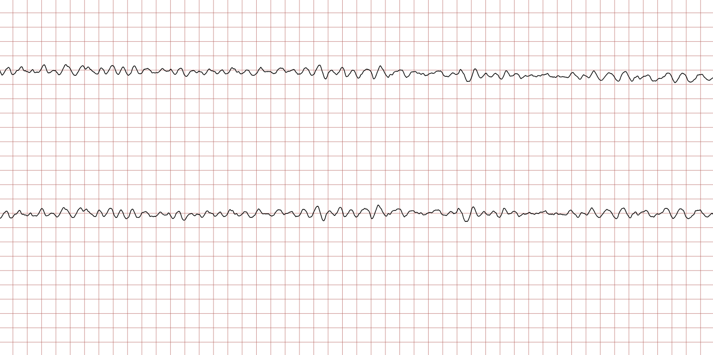 EKG 6 (Fall 2): wieder grobes Kammerflimmern mit größeren Flimmerwellen