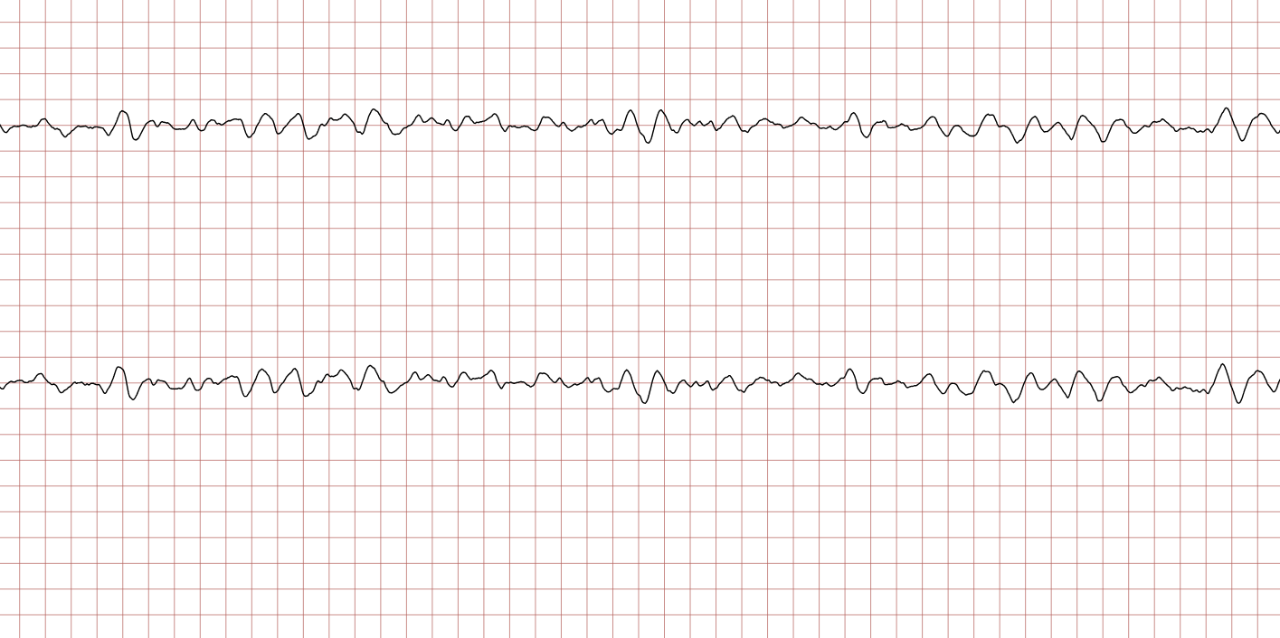 EKG 8 (Fall 2): fortbestehendes Kammerflimmern