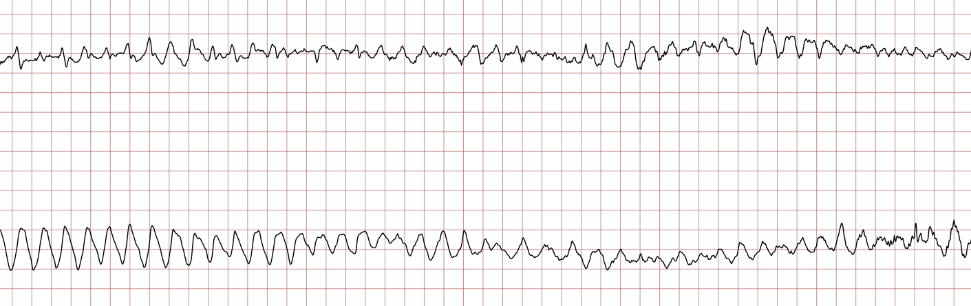 EKG 2 (Fall 3): anhaltende ventrikuläre Tachykardie