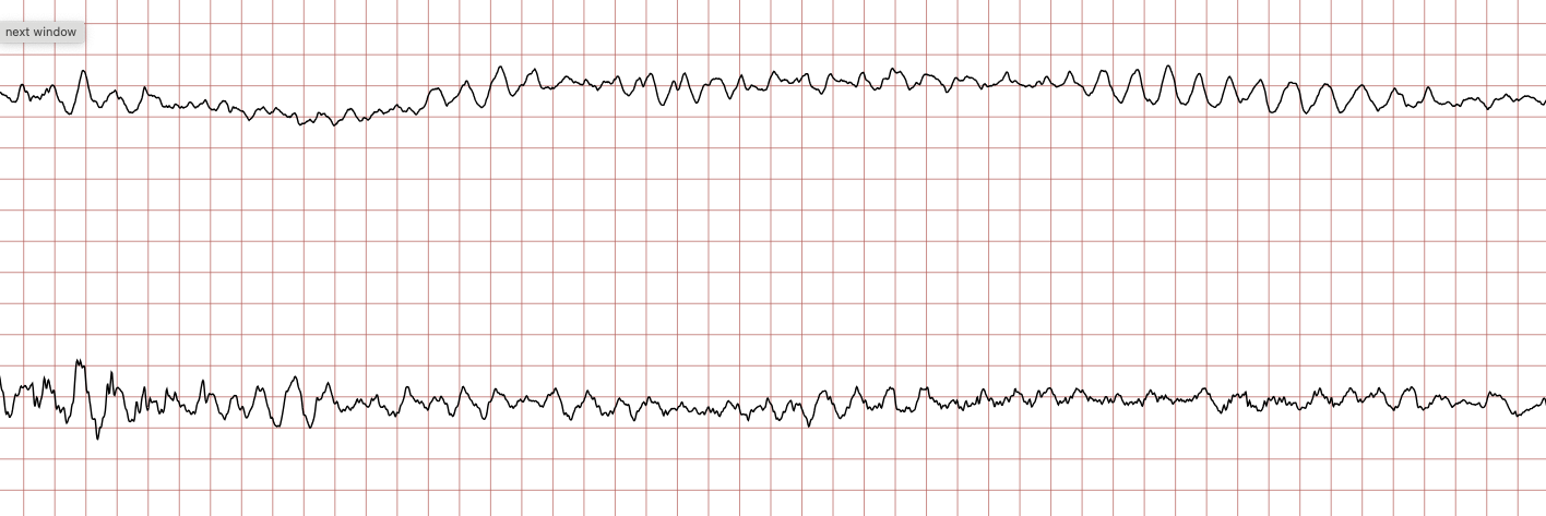EKG 3 (Fall 3): Kammerflimmern mit unregelmäßigen Flimmerwellen ohne abgrenzbare QRS-Komplexe