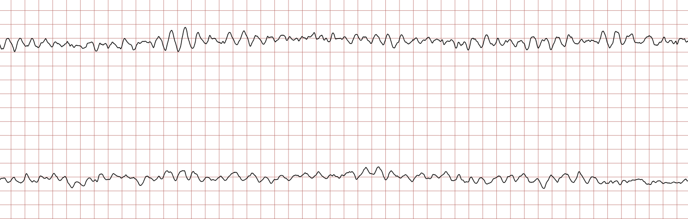 EKG 5 (Fall 3): fortbestehendes Kammerflimmern