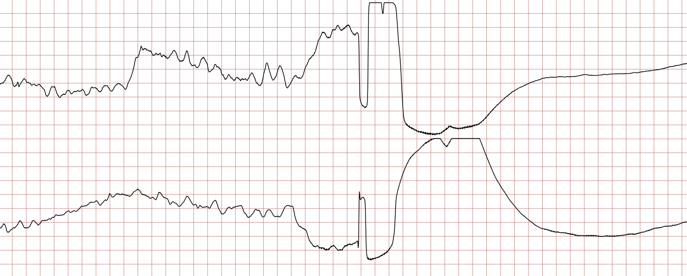 EKG 6 (Fall 3): Schockartefakt bei Kammerflimmern, danach flache Linie im Sinne einer Asystolie