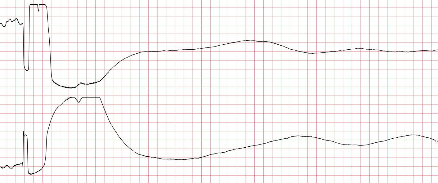 EKG 7 (Fall 3): Asystolie nach dem Schock