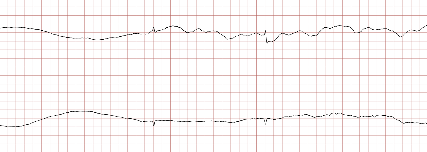 EKG 8 (Fall 3): nach der Asystolie kehren supraventrikuläre Komplexe zurück