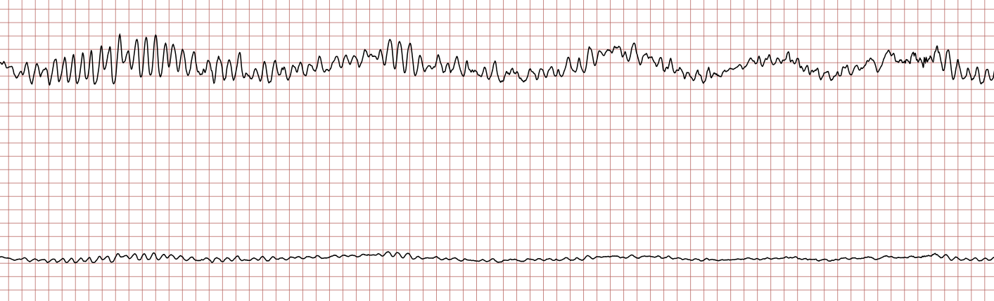 EKG 4 (Fall 5): weiterer Übergang der polymorphen VT in Kammerflimmern