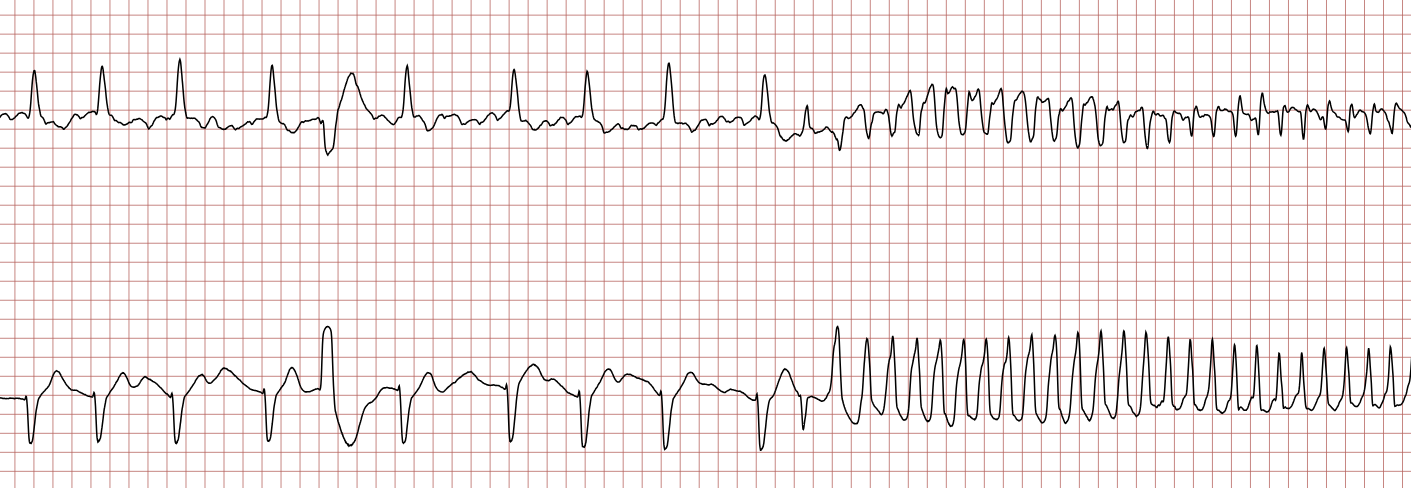 EKG 1 (Fall 6): zwei Kanäle mit Vorhofflimmern, der fünfte Schlag ist eine ventrikuläre Extrasystole, aus der eine ventrikuläre Tachykardie entsteht