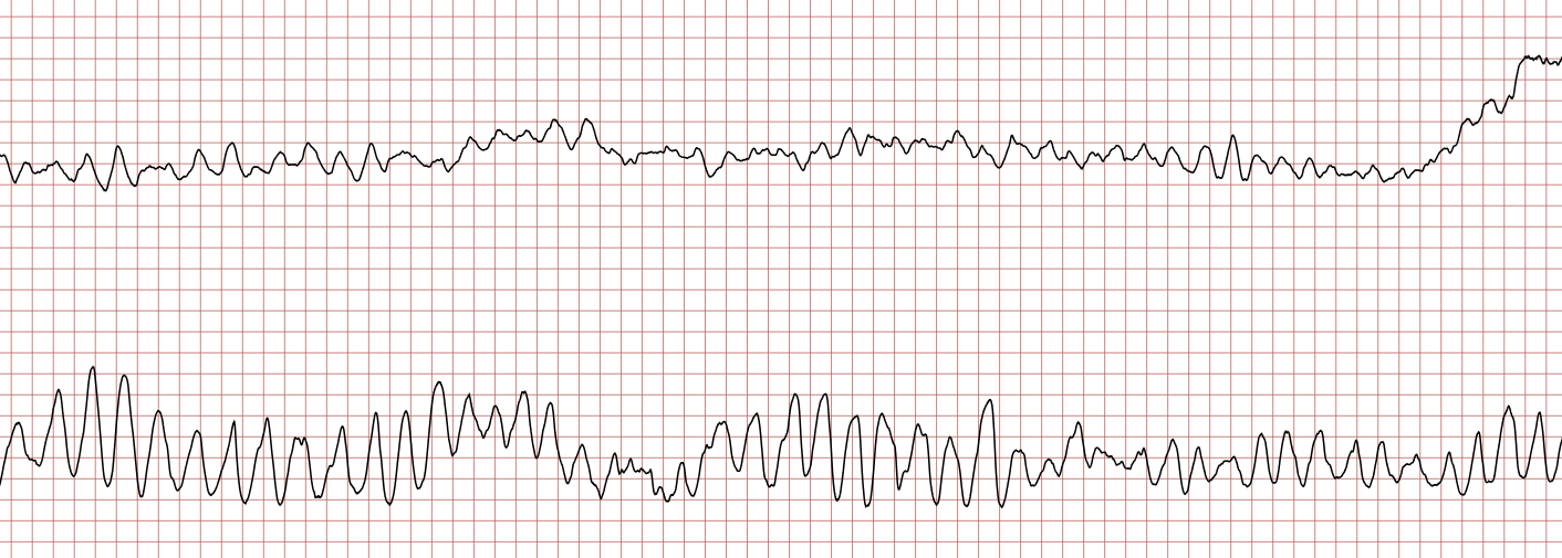 EKG 2 (Fall 6): obere Ableitung sehr ungeordnet mit noch erkennbaren QRS-Komplexen, untere Ableitung mit polymorpher ventrikulärer Tachykardie