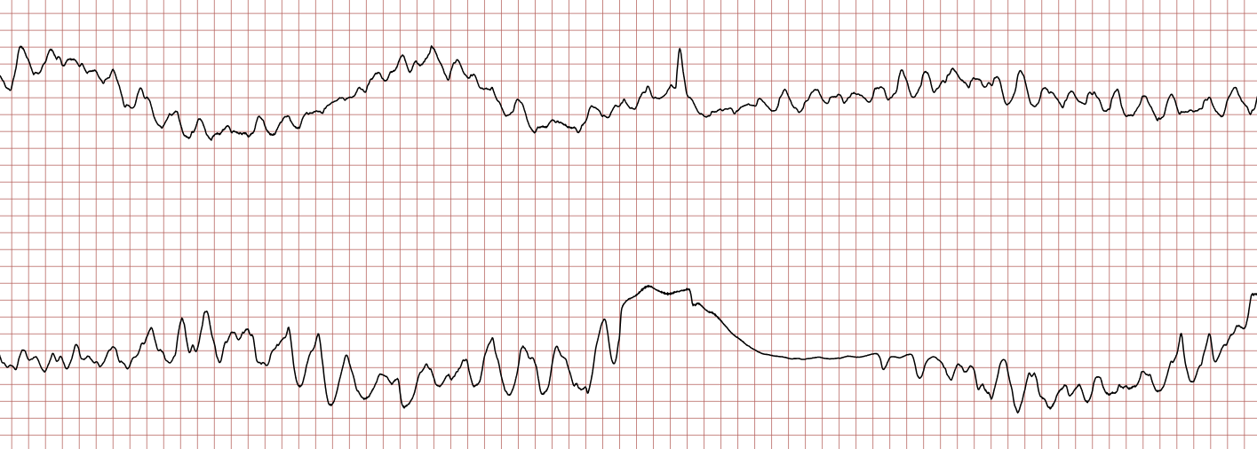 EKG 3 (Fall 6): fortbestehende polymorphe ventrikuläre Tachykardie oder Kammerflattern