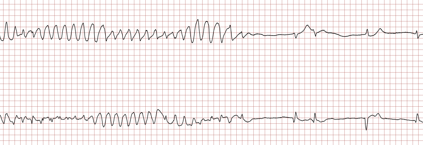 EKG 4 (Fall 7): erneute ventrikuläre Tachykardie, die wieder spontan endet