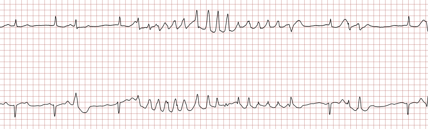 EKG 5 (Fall 7): weitere polymorphe ventrikuläre Tachykardie, die von selbst endet
