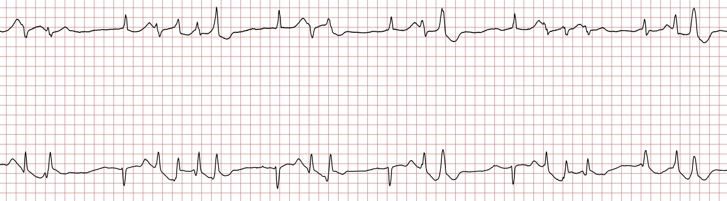EKG 7 (Fall 7): anhaltende ventrikuläre Extrasystolen und weitere VT-Salven