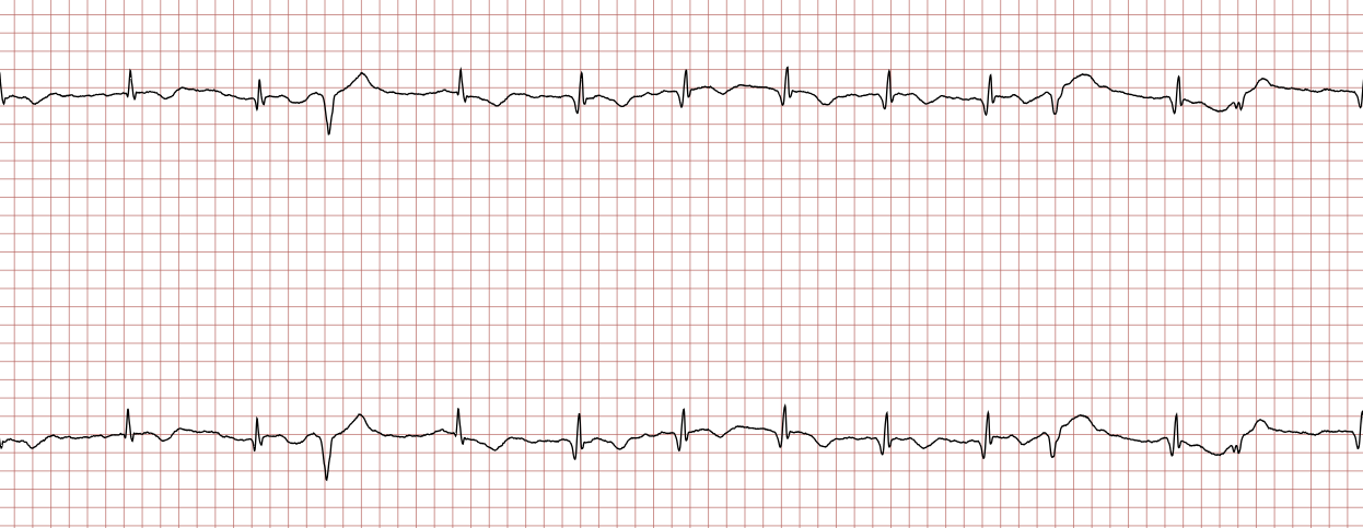 EKG 4 (Fall 8): ST-Strecken-Hebungen und Q-Zacken, die in der ersten Registrierung nicht vorhanden waren