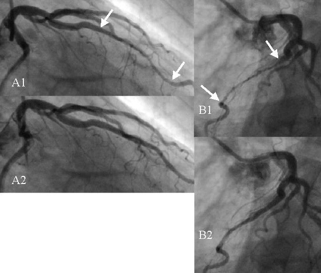 Koronarangiographie einer Myokardbrücke im Ramus interventricularis anterior, in Systole (A1) mit komprimiertem Segment und in Diastole (A2)